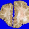 2A7 Hemimegalencephaly (Case 2) 3A