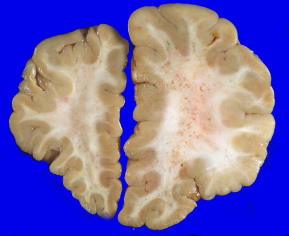 2A7 Hemimegalencephaly (Case 2) 3A