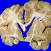 2A8 Hemimegalencephaly (Case 2) 4A