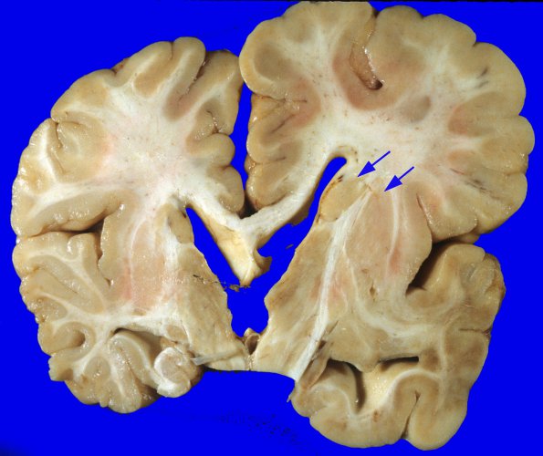 2A8 Hemimegalencephaly (Case 2) 4A