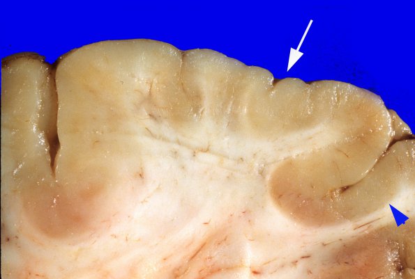 2A9 Hemimegalencephaly (Case 2) closeup cortex A