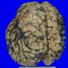 3A1 Hemimegalencephaly, Polymicrogyria, Heterotopia (Case 3) A1A