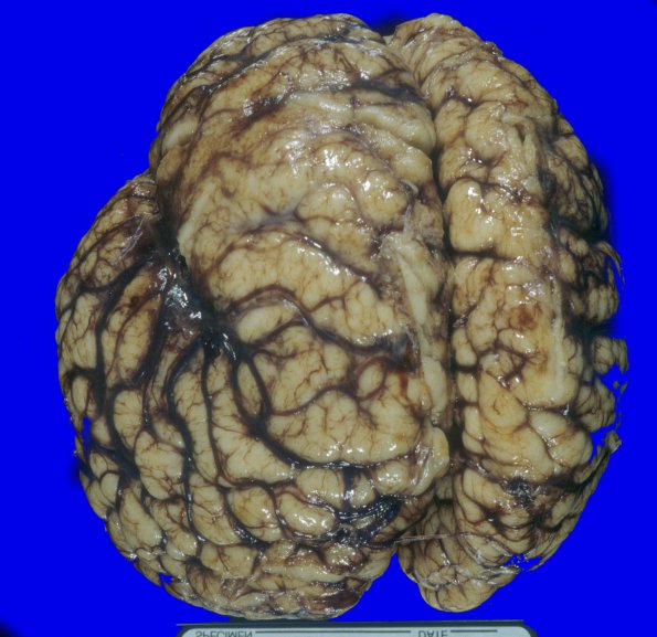 3A1 Hemimegalencephaly, Polymicrogyria, Heterotopia (Case 3) A1A