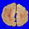 3A2 Hemimegalencephaly (Case 3) polymicrogyriaA