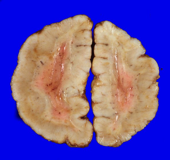 3A2 Hemimegalencephaly (Case 3) polymicrogyriaA