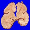 3A4 Hemimegalencephaly, Polymicrogyria, Heterotopia (Case 3) A10A