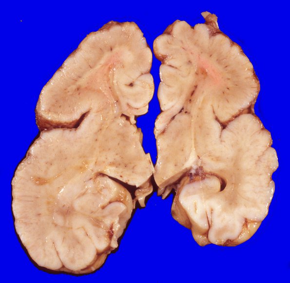 3A4 Hemimegalencephaly, Polymicrogyria, Heterotopia (Case 3) A10A