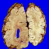 3A5 Hemimegalencephaly, Polymicrogyria, Heterotopia (Case 3) A2A