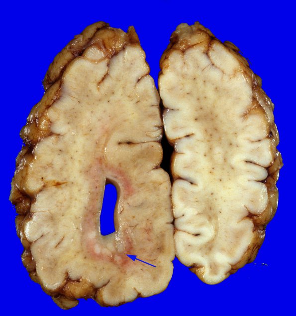 3A5 Hemimegalencephaly, Polymicrogyria, Heterotopia (Case 3) A2A