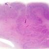 3B1 Polymicrogyria, focal (Case 3) H&E whole mount