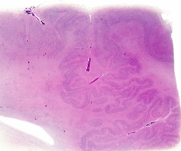 3B1 Polymicrogyria, focal (Case 3) H&E whole mount