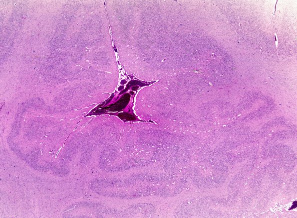 3B2 Polymicrogyria (Case 3) H&E whole mount