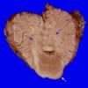 3C1 Hemimegalencephaly, Polymicrogyria, Heterotopia (Case 3) A5A