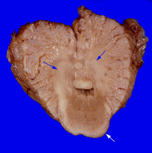 3C1 Hemimegalencephaly, Polymicrogyria, Heterotopia (Case 3) A5A