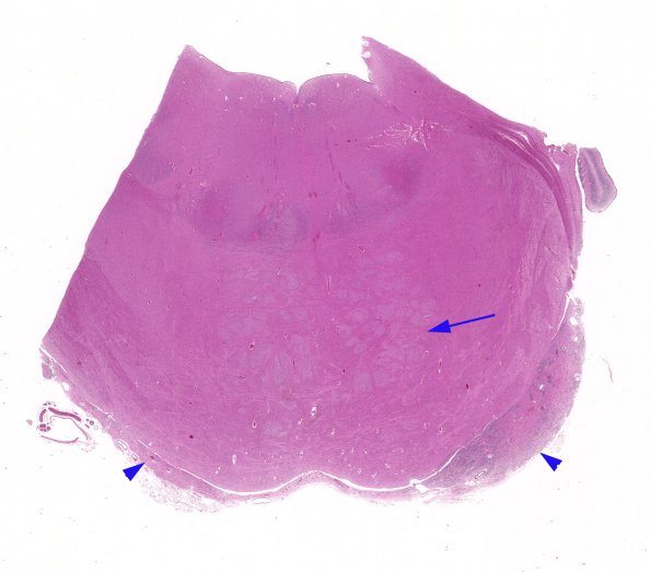 3C2 Pontine defect, leptomeningeal heterotopia (Case 3) H&E 2