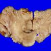 3D1 Hemimegalencephaly, Polymicrogyria, Heterotopia, (Case 3) A6 (2) A