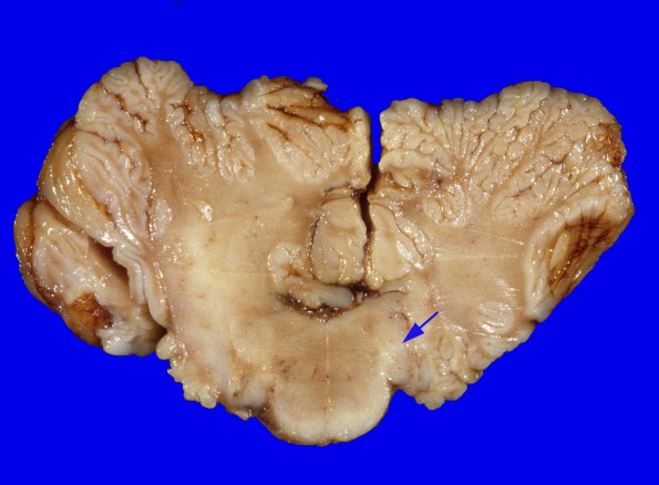 3D1 Hemimegalencephaly, Polymicrogyria, Heterotopia, (Case 3) A6 (2) A