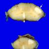 Hemimegalencephaly