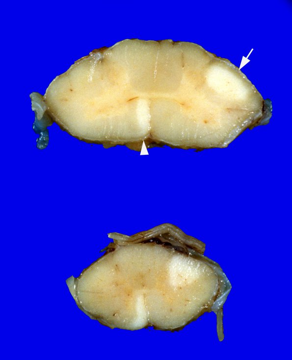 3E Hemimegalencephaly, Polymicrogyria, Heterotopia (Case 3) A12A