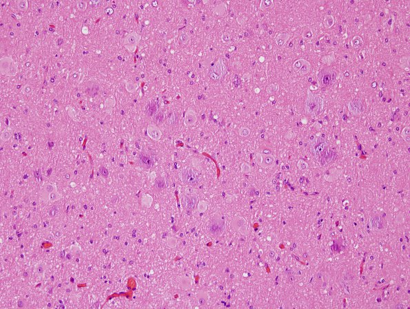 4A2 Focal Cortical Dysplasia (Case 4) H&E 3