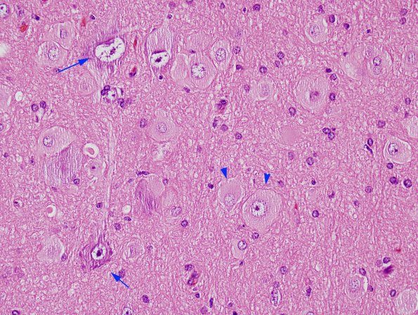 4A3 Focal Cortical Dysplasia (Case 4) H&E 4