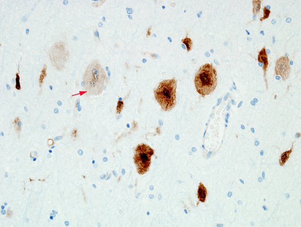 4B1 Focal Cortical Dysplasia (Case 4) NeuN