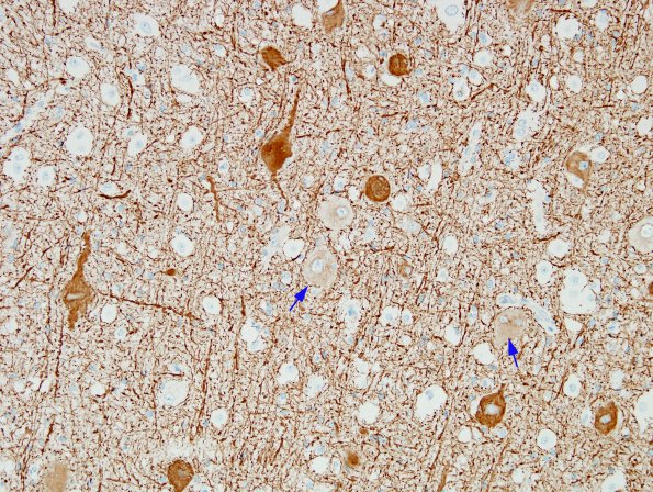 4B2 Focal Cortical Dysplasia (Case 4) NF 5