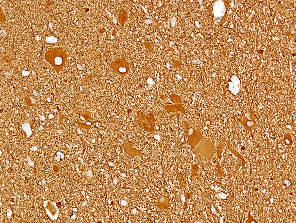 4B3 Focal Cortical Dysplasia (Case 4) GFAP 1