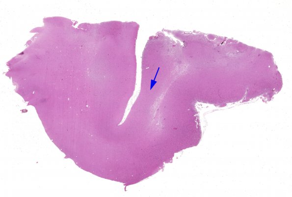 5A1 Hemimegalencephaly (Case 5) H&E 1