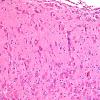 5A3 Hemimegalencephaly (Case 5) H&E 6