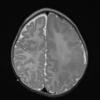 6A1 Malformation, neuronal, hemihypertrophy (Case 6) T2 1