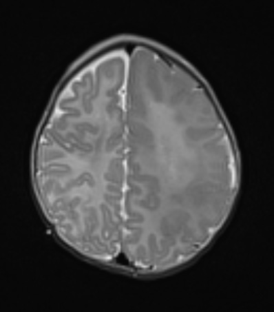 6A1 Malformation, neuronal, hemihypertrophy (Case 6) T2 1