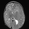 6A2 Malformation, neuronal, hemihypertrophy (Case 6) T2 3