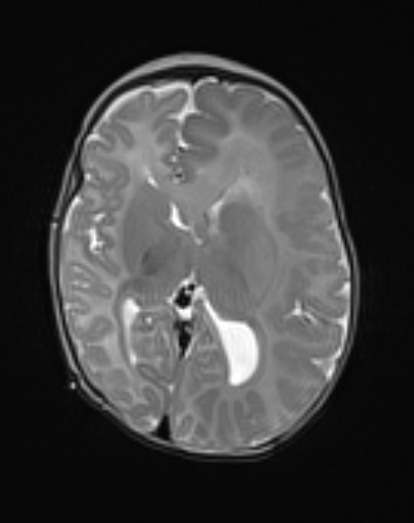 6A2 Malformation, neuronal, hemihypertrophy (Case 6) T2 3