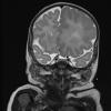 6A3 Malformation, neuronal, hemihypertrophy (Case 6) T2 5