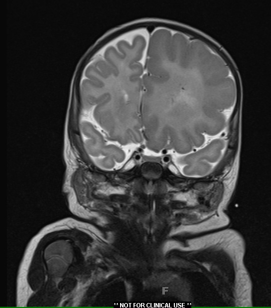 6A3 Malformation, neuronal, hemihypertrophy (Case 6) T2 5