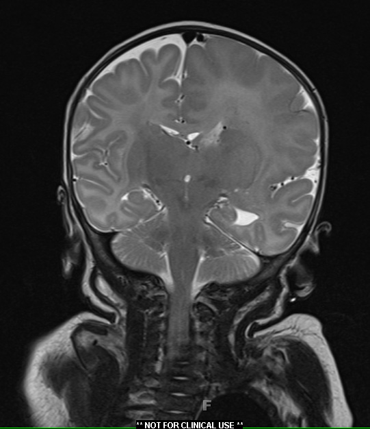 6A4 Malformation, neuronal, hemihypertrophy (Case 6) T2 7