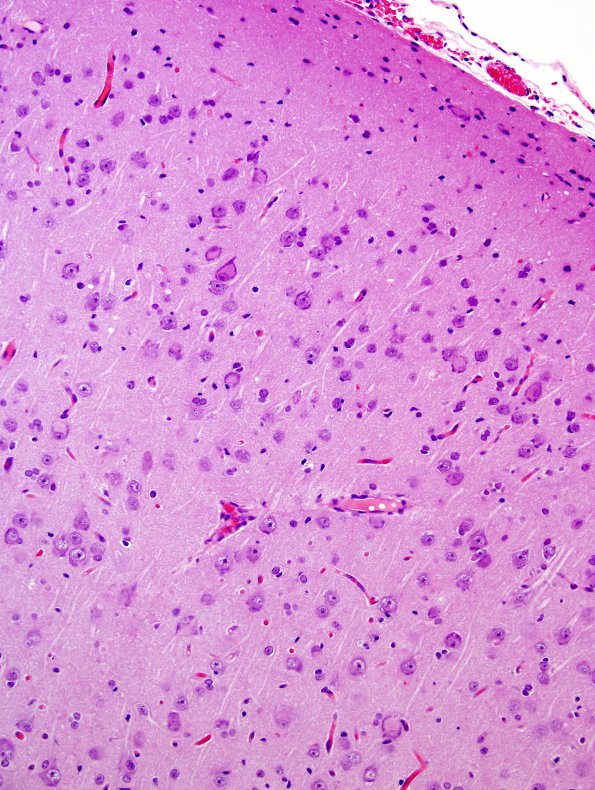 6B2 Malformation, neuronal, hemihypertrophy (Case 6) H&E 3