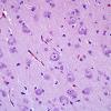 6B3 Hemimegalencephaly (Case 6) scale