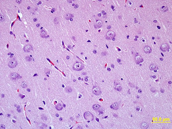 6B3 Hemimegalencephaly (Case 6) scale