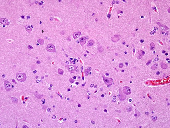 6B5 Hemimegalencephaly (Case 6) H&E 1