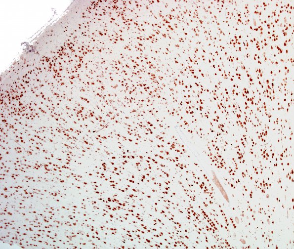 6C1 Malformation, neuronal, hemihypertrophy (Case 6) NeuN 5A