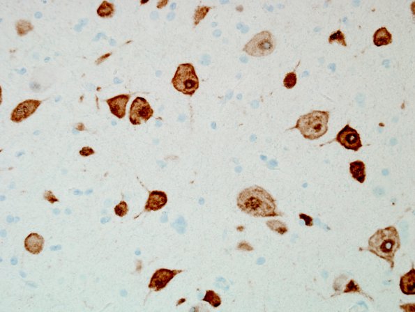 6C3 Malformation, neuronal, hemihypertrophy (Case 6) NeuN 1