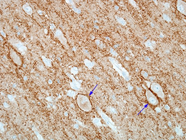 6C4 Hemimegalencephaly (Case 6) SYN 40X