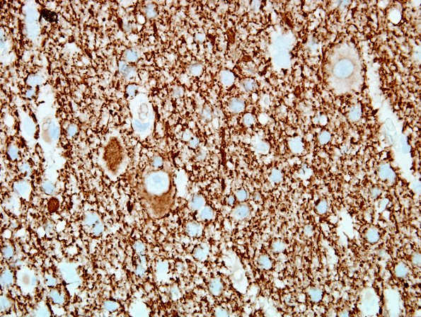 6C5 Hemimegalencephaly (Case 6) NF 40X 3