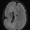 7A1 Hemimegalencephaly (Case 8) FLAIR 1