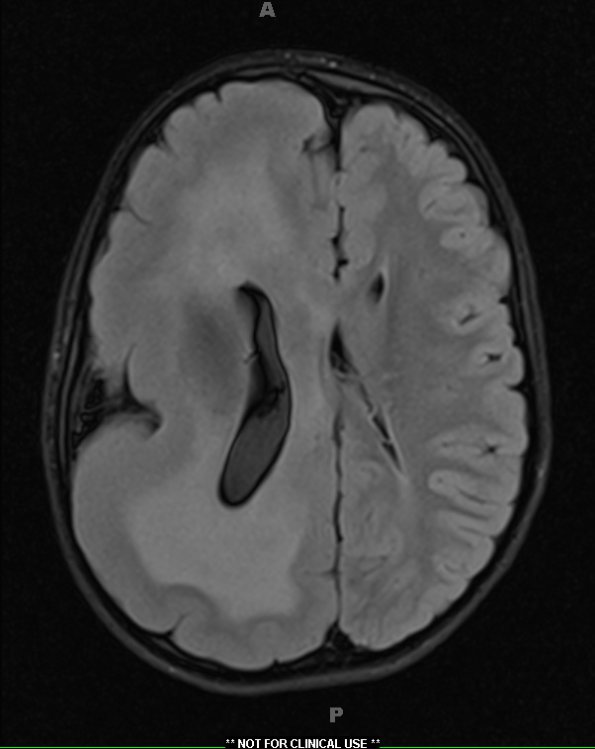 7A1 Hemimegalencephaly (Case 8) FLAIR 1