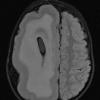 7A2 Hemimegalencephaly (Case 8) FLAIR 2