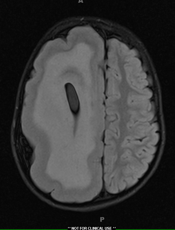 7A2 Hemimegalencephaly (Case 8) FLAIR 2