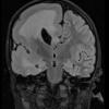 7A3 Hemimegalencephaly (Case 8) FLAIR 3